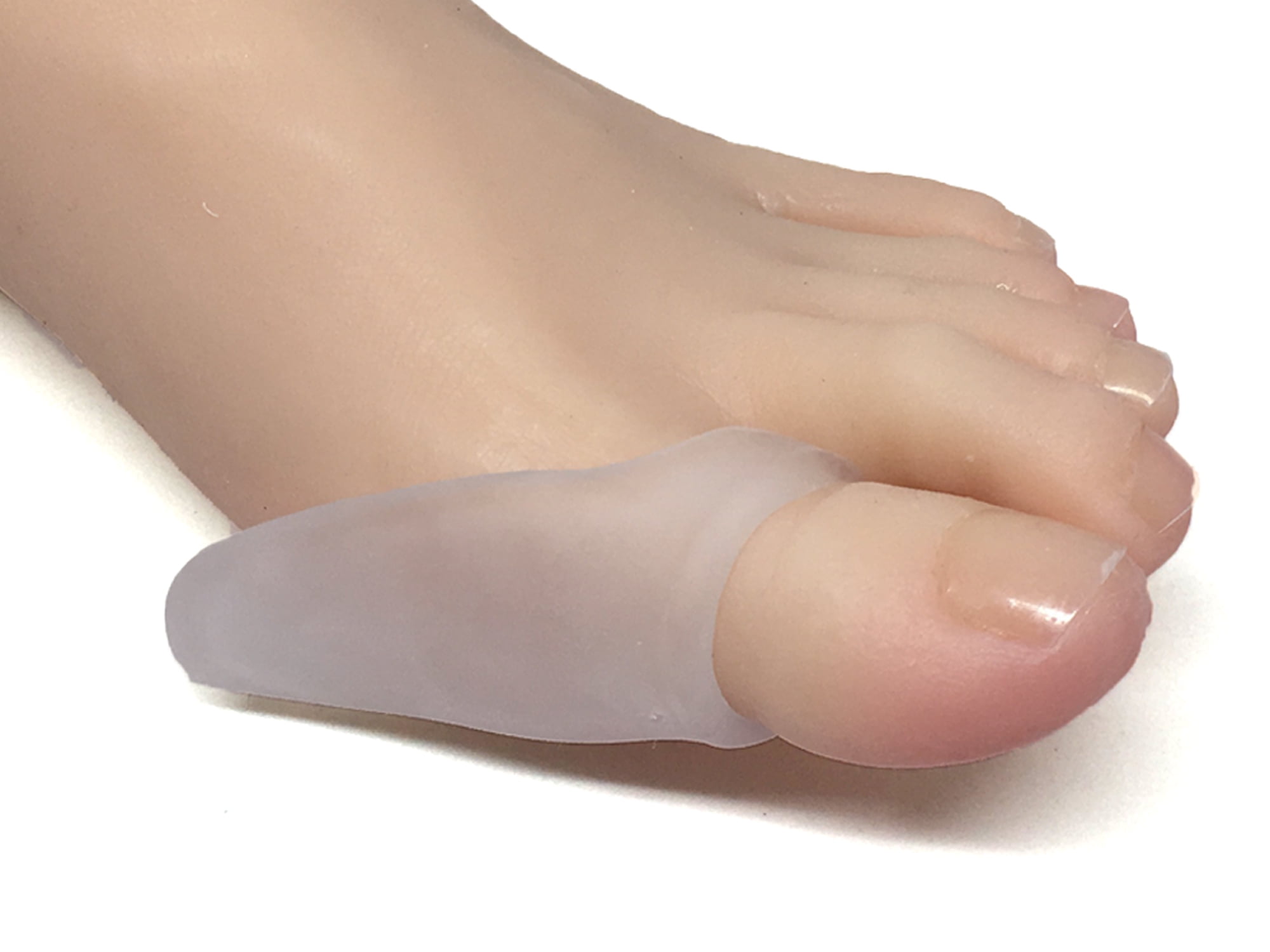 bunions on thumbs Bunions on thumbs
